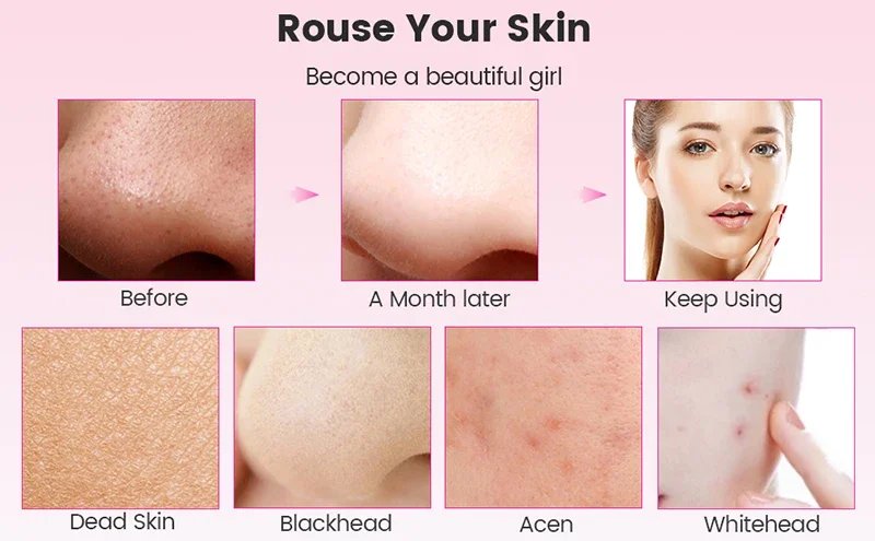 Ultrasonic Skin Care Spatula Vibration Blackhead Remover Cavitation Shovel Facial Exfoliation Skin Care Tools